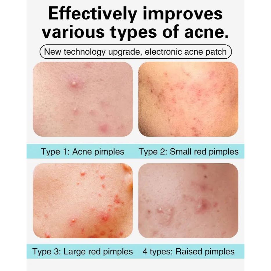 acne3